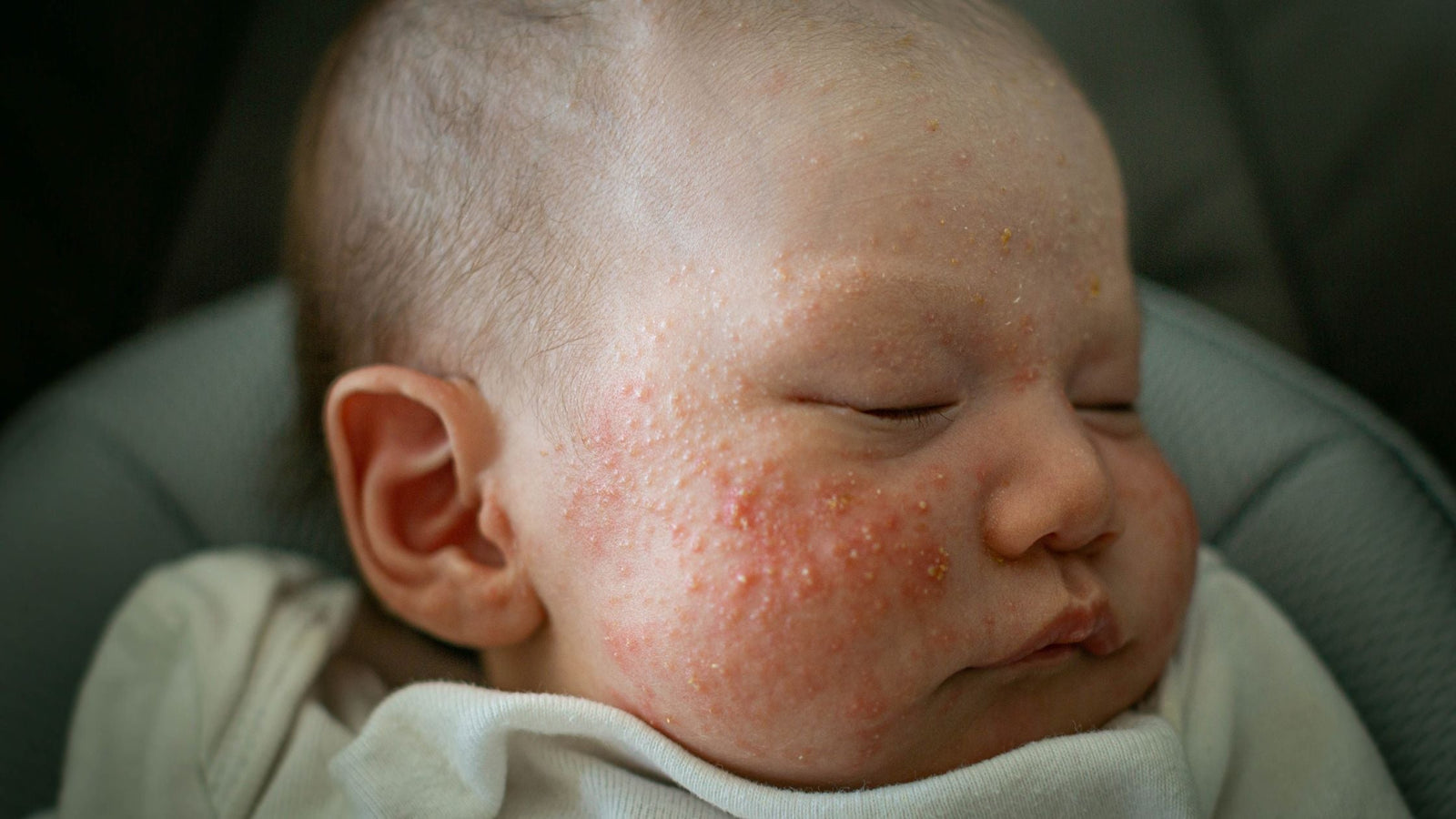 Understanding and Treating Baby Acne: A Parent's Guide