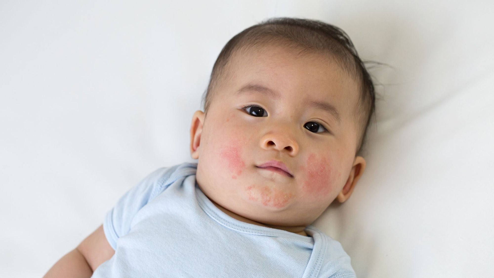 Understanding Baby Eczema: Causes, Triggers, and Natural Solutions