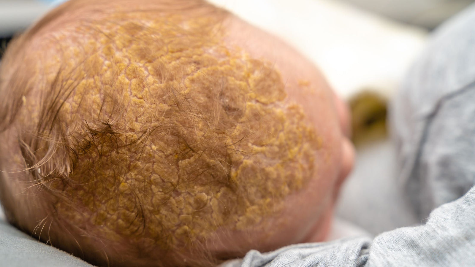 Understanding and Treating Cradle Cap: A Complete Guide For Parents