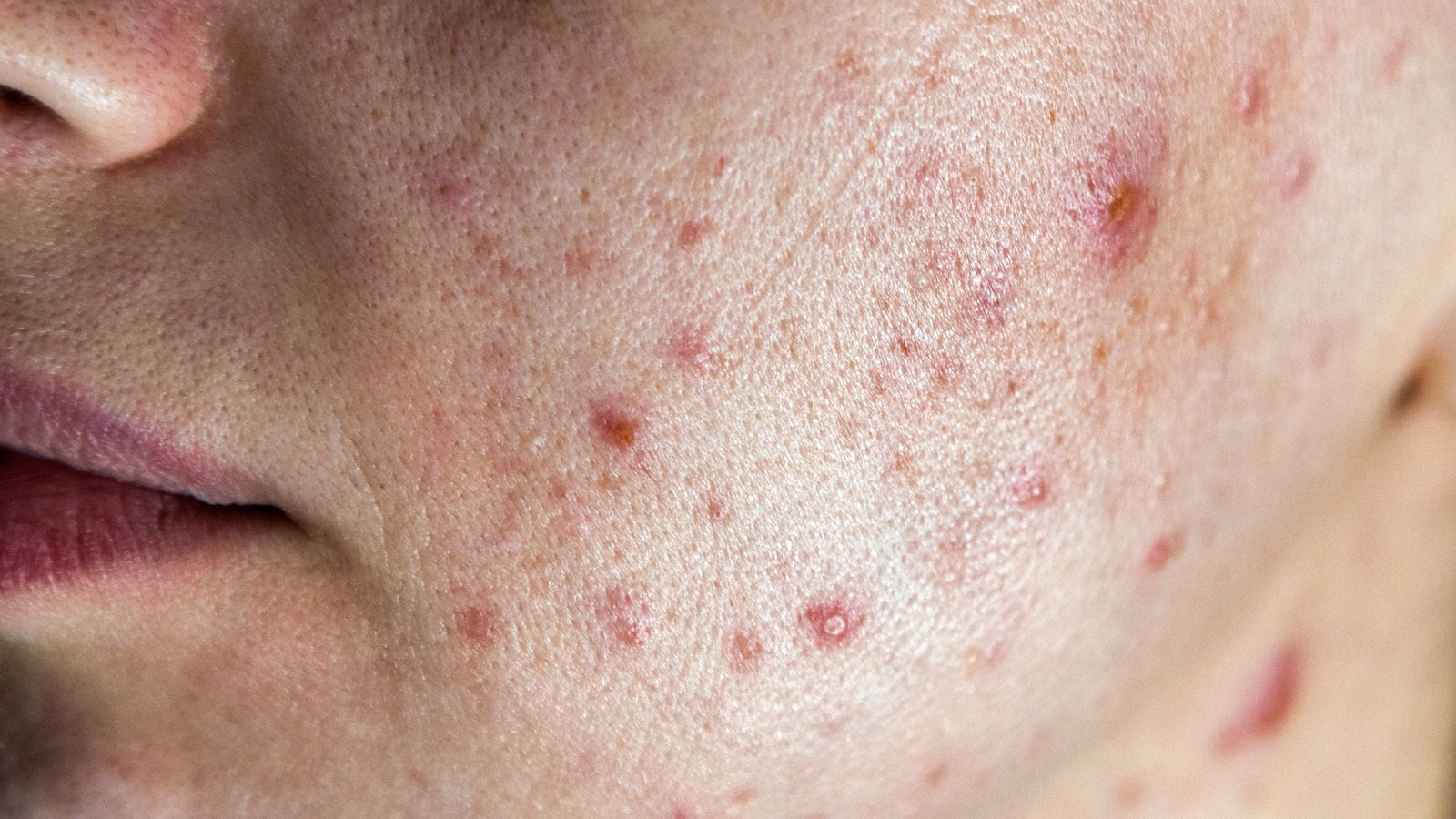 Nontoxic Skincare Products For Acne: A Step-By-Step Routine